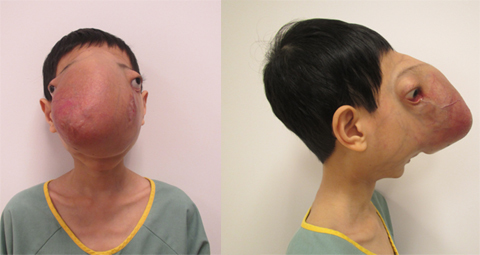 Phẫu thuật cho “cậu bé không có khuôn mặt của người”