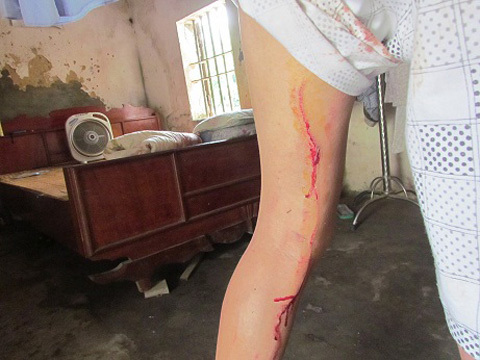 Bỗng dưng bị lợn rừng tấn công, 2 người bị thương