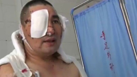 Gặp người đàn ông bị chặt tay vì tố cáo tham nhũng