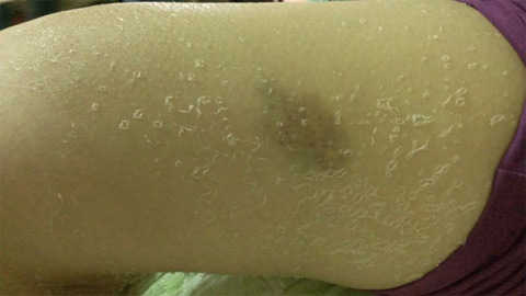 Tắm trắng, cô gái Hà Nội bị 