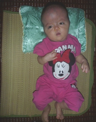 Lời khẩn cầu của gia đình bé mắc hội chứng Apert