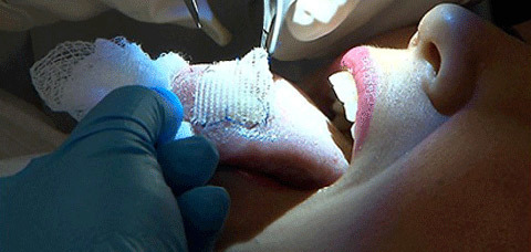 Kinh hoàng cách giảm cân “vá lưỡi’