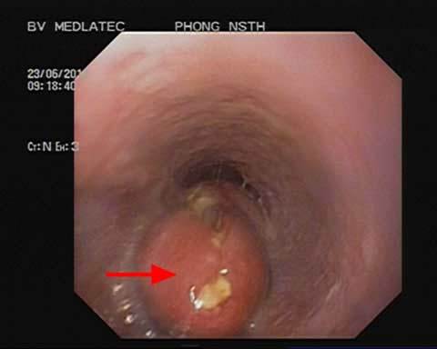 Được giáo sư hội chẩn mới phát hiện ung thư