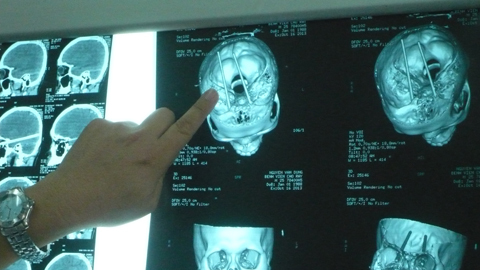 Liên tiếp 3 vụ ‘xử nhau' bằng đũa trên bàn nhậu