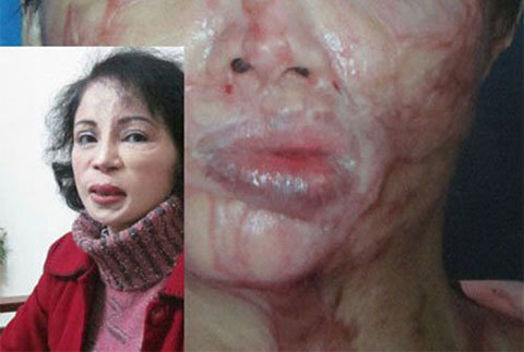 Gặp người 41 lần phẫu thuật làm đẹp: 'Bác sĩ Việt quá tham'