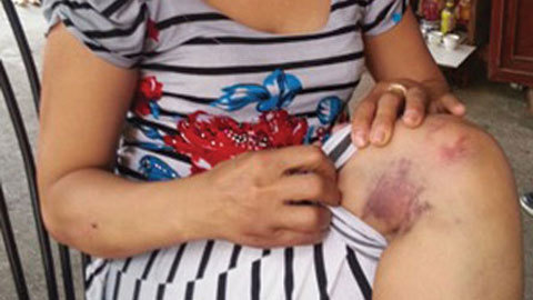 Một phụ nữ bị chồng đánh đập dã man