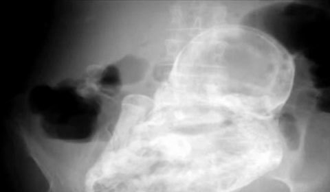 Bào thai 40 tuổi nằm trong bụng bà lão 82