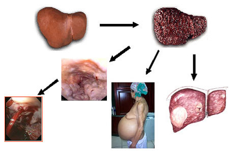 Công bố đột biến virus khiến người viêm gan B mắc ung thư