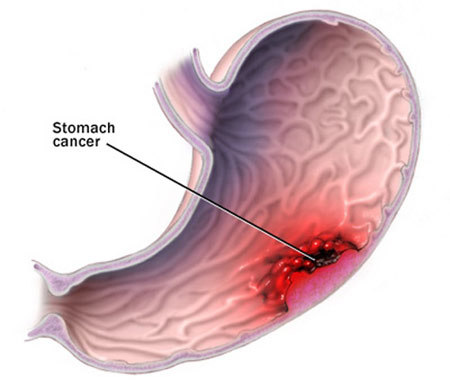 Phát hiện sớm ung thư dạ dày