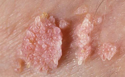 Mắc sùi mào gà vì nghĩ ô sin 'an toàn'