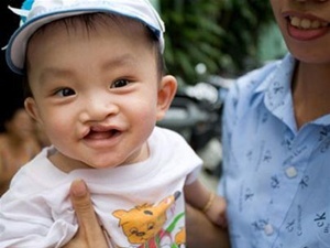 Đăng kí phẫu thuật miễn phí cho trẻ em hở môi, vòm miệng