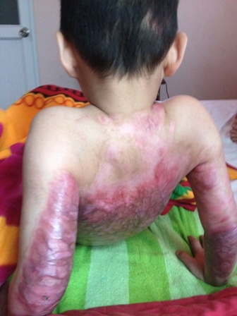 Không có 300 triệu, bé gái sẽ bị tàn phế suốt đời