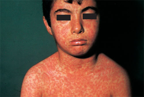 Để trẻ nhỏ không ‘‘dính’’ bệnh sởi