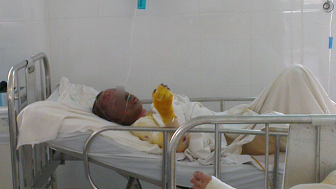 Nạn nhân bỏng nặng nhất vụ nổ thùng thép đã tử vong