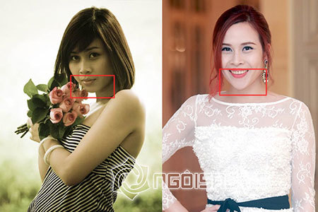 Lưu Hương Giang dính nghi án độn cằm nhọn hoắt