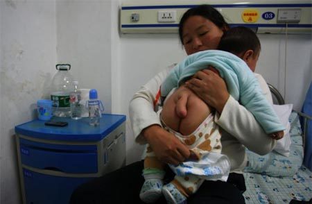 bé trai, mọc đuôi, dị thường, tật nứt đốt sống