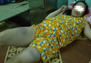 Đánh vợ dã man vì đi khám thai không báo trước