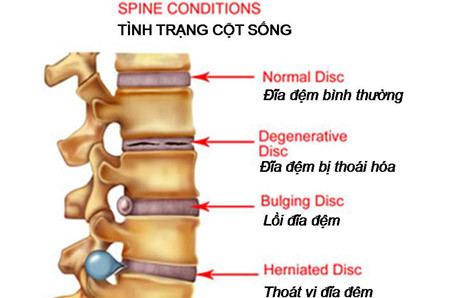 Thoái hóa cột sống - chứng bệnh phổ biến của U40