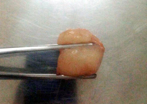 Lo lắng: Trẻ hóc dị vật nguy hiểm đầu hè