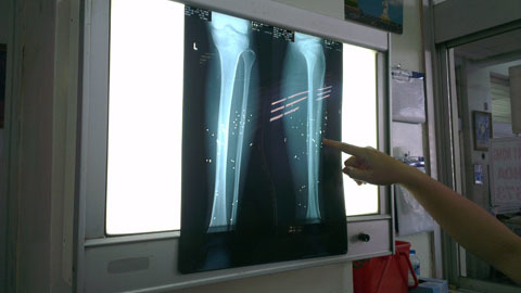 Bắn nhau vì tranh chấp đất: Nạn nhân bị găm nhiều mảnh đạn