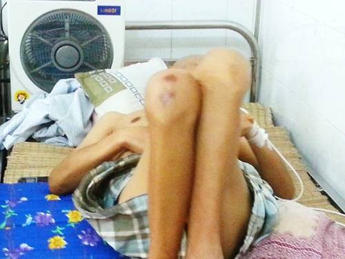 Rùng mình chứng kiến nạn nhân thuốc lá quằn quại trên giường bệnh