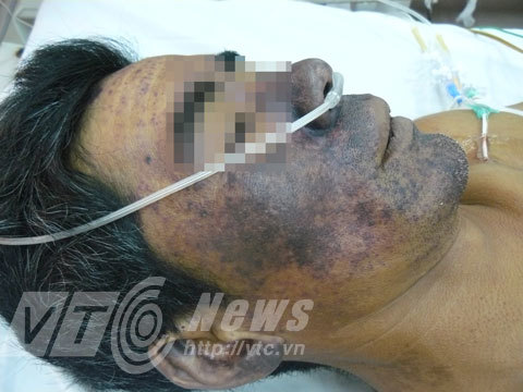 Những hình ảnh gây sốc về ngộ độc tiết canh dê