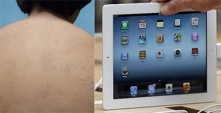 iPad có thể gây phát ban, dị ứng?