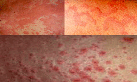 20% dân số Việt Nam mắc các bệnh dị ứng, mề đay