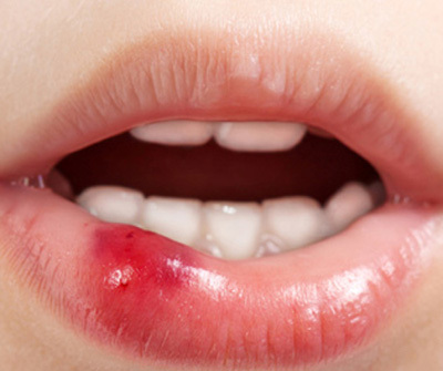 Kỹ năng sơ cứu khi bé bị thương ở miệng