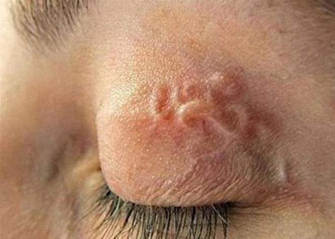 Ấu trùng, giun, sán 'tung tăng' trong cơ thể người