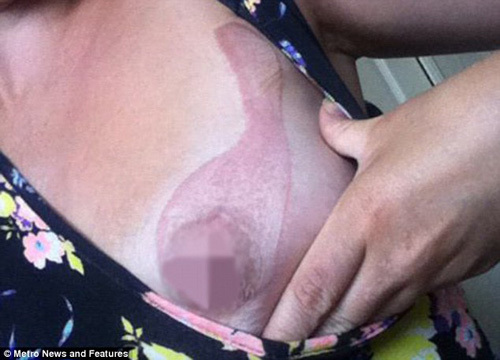 iPhone 4 đang sạc gây bỏng nửa ngực cô gái