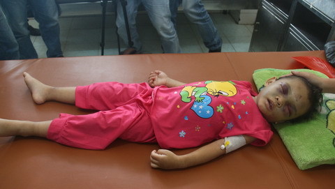 Bất hạnh tột cùng bé gái 4 tuổi bị đánh chấn thương sọ não