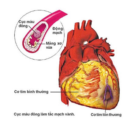 Xơ vữa động mạch: Nguyên nhân chính gây đột quỵ