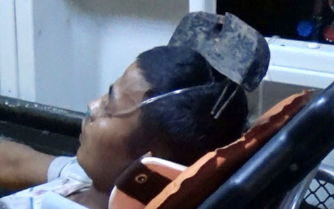 Sống sót kỳ diệu sau khi bị 2 thanh sắt xuyên não