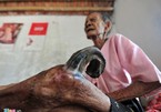 Nam Định: Cụ bà 97 tuổi mọc sừng 20cm