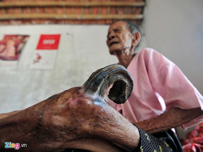 Nam Định: Cụ bà 97 tuổi mọc sừng 20cm