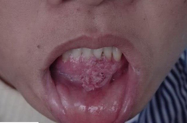 Hôn bạn trai, mắc ngay sùi mào gà quanh miệng