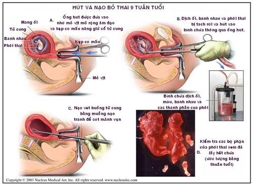 Vô sinh vì phá thai nhiều lần, cầu xin bác sĩ nói dối chồng