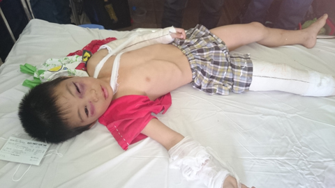 Bị cha dượng đánh nứt sọ vì…lén xem ti vi