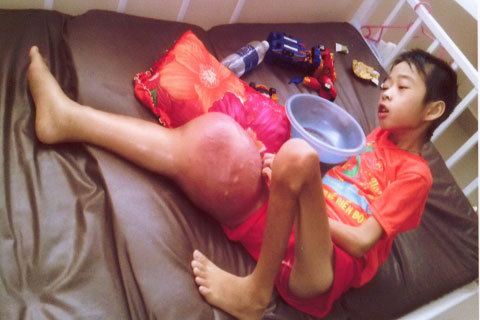 Mẹ vừa mổ sỏi mật, con lại ung thư