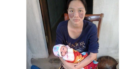 Xót lòng người mẹ trẻ bệnh nặng không tiền chữa trị