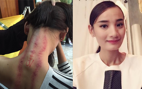 Cơ thể siêu mẫu Lê Thúy xuất hiện những vết đỏ đáng sợ