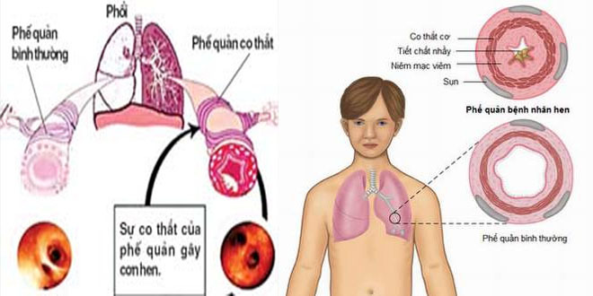 Khám miễn phí bệnh hen phế quản