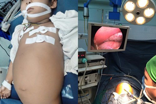 Cứu sống bé 5 tuổi người Lào có khối u 'khổng lồ'