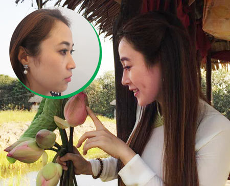 Nâng mũi S Line: Xấu - đẹp do đâu?