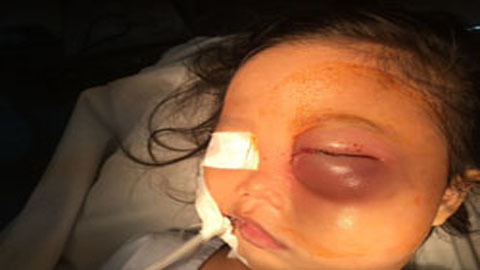 Bị khỉ cắn, bé gái 4 tuổi suýt mất 1 mắt
