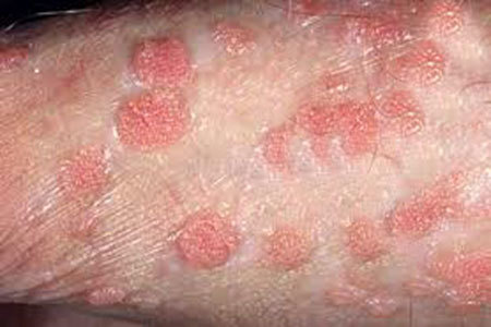 Mắc sùi mào gà từ ông chủ, thiếu nữ hốt hoảng vì loét miệng