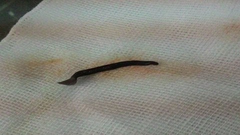 Gắp con đỉa dài gần 5cm từ mũi bệnh nhân