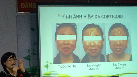 Hiểm hoạ từ công thức chế kem đẹp da có chứa corticoid
