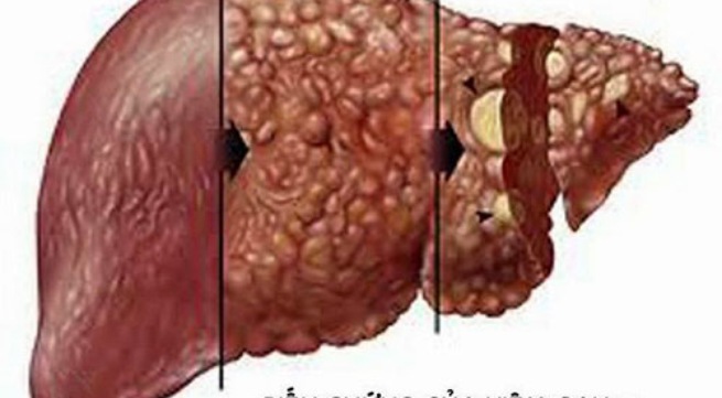 Biến chứng nguy hiểm của viêm gan B mạn tính